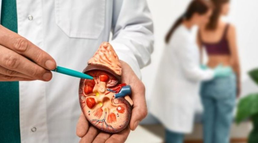 Çfarë shkakton gurët në veshka? Mitet dhe faktet mjekësore