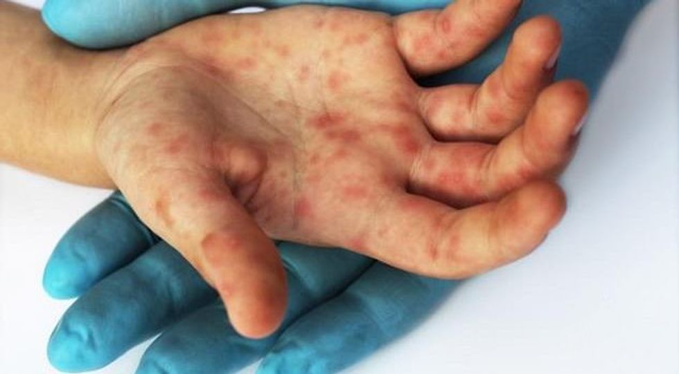 Fruthi përhapet në institucione parashkollore, KOMF kërkon vaksinim të detyrueshëm