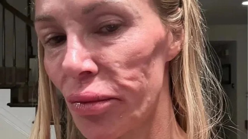 Brandi Glanville tregon tmerrin e implantëve të gjoksit që i shpërfytyruan fytyrën