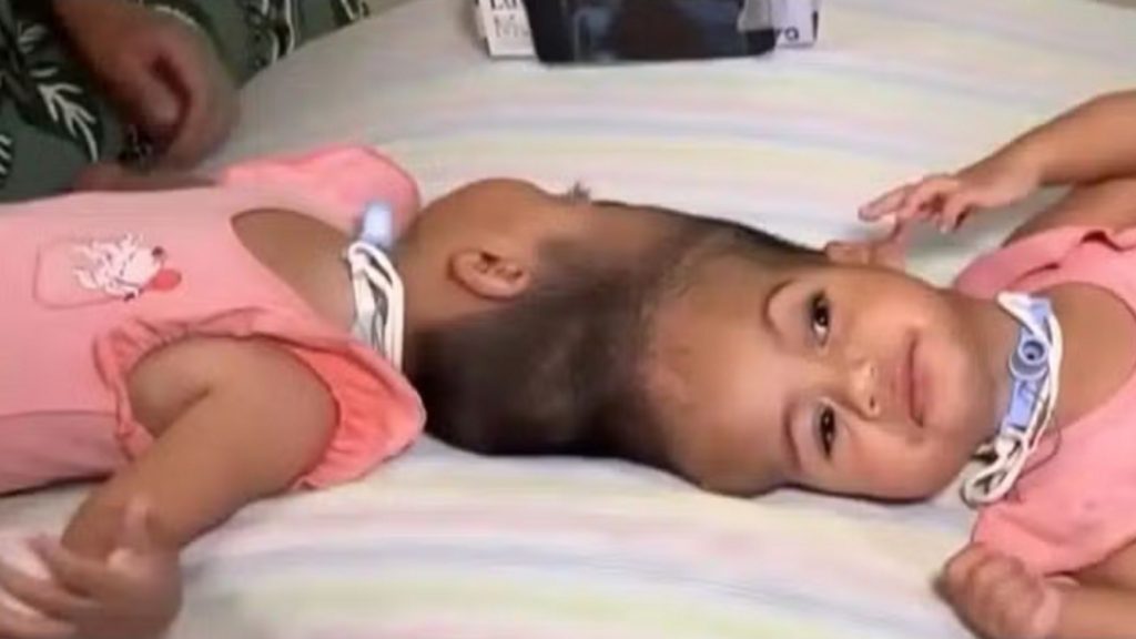 Operacioni i gjatë për ndarjen e binjakeve të bashkuara në kokë përfundon tragjikisht